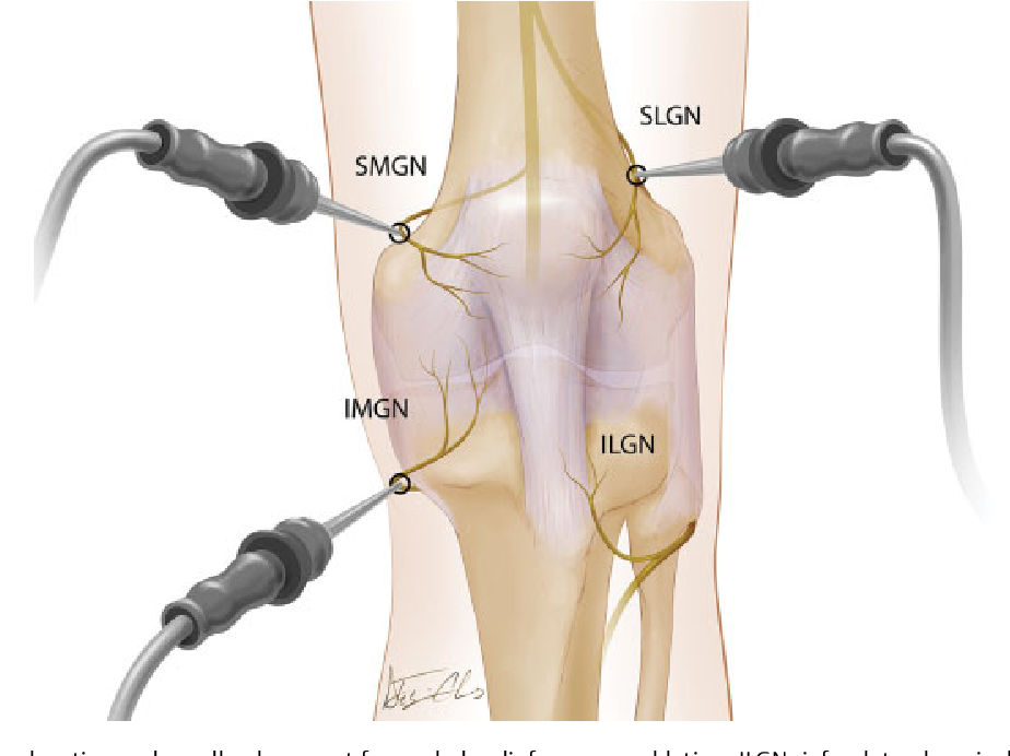 Knee Joint Radio Frequency