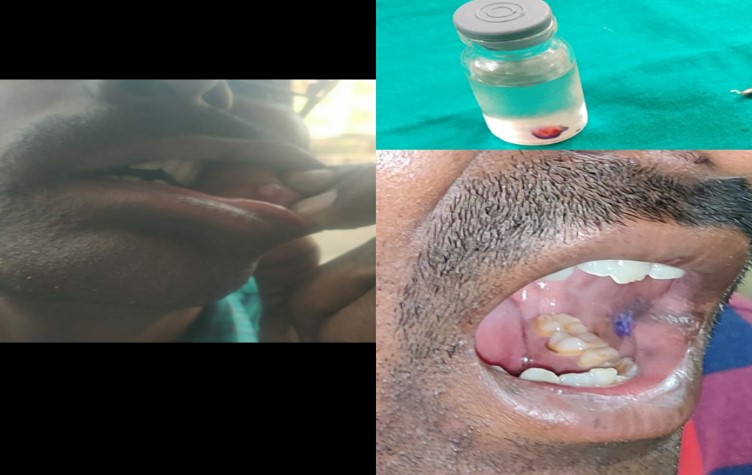 oral cyst