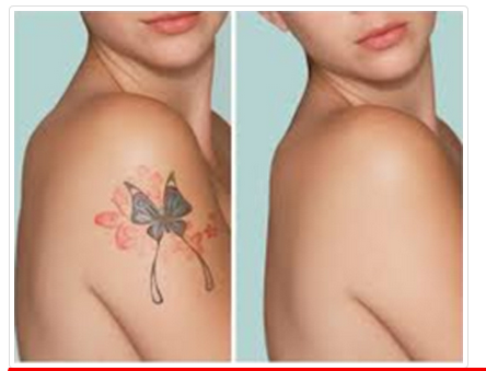 laser-tatto-removal-treatment-in-chinchwad