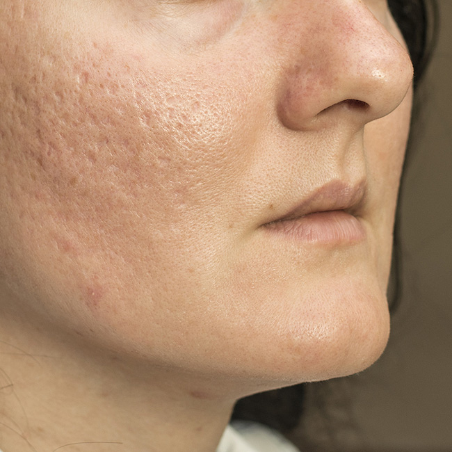 acne-scar-treatment-in-pimprichinchwad