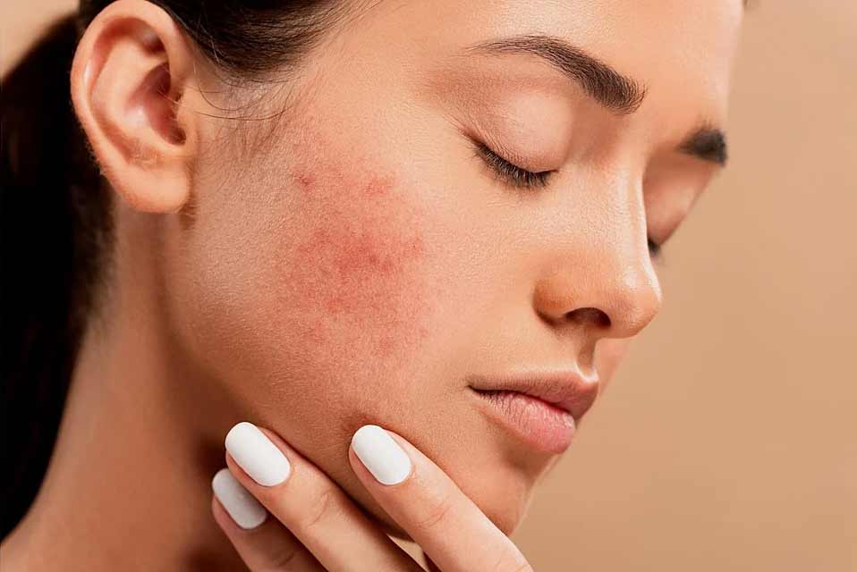 Pimples Treatments