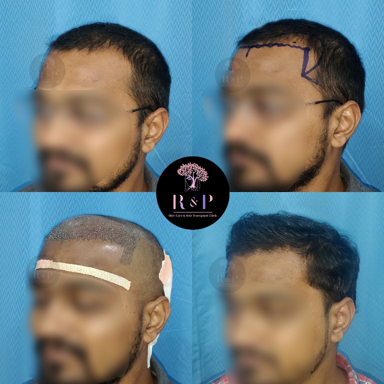 results-hairtransplant-drrashmiaderao-bizknow.in-1