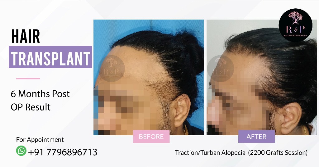 results-hairtransplant-drrashmiaderao-bizknow.in-2