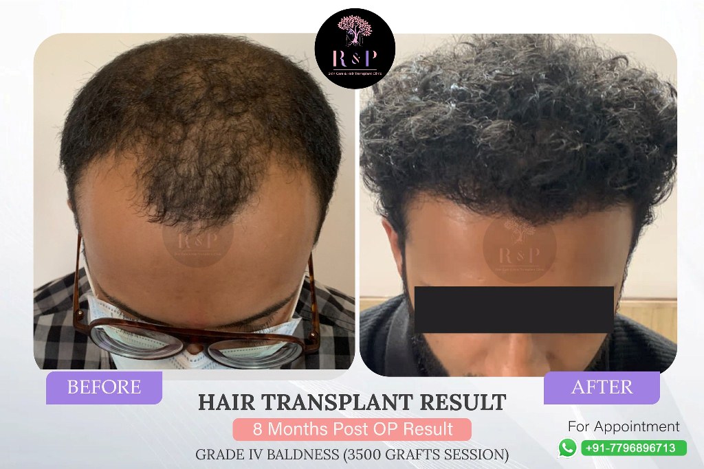 results-hairtransplant-drrashmiaderao-bizknow.in-3