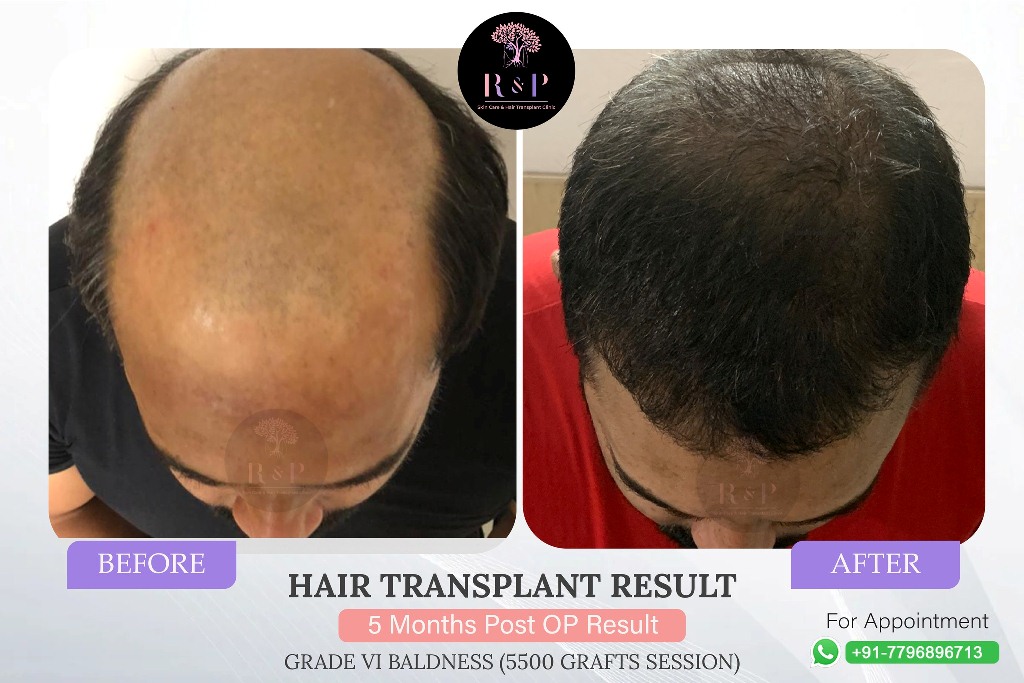 results-hairtransplant-drrashmiaderao-bizknow.in-4