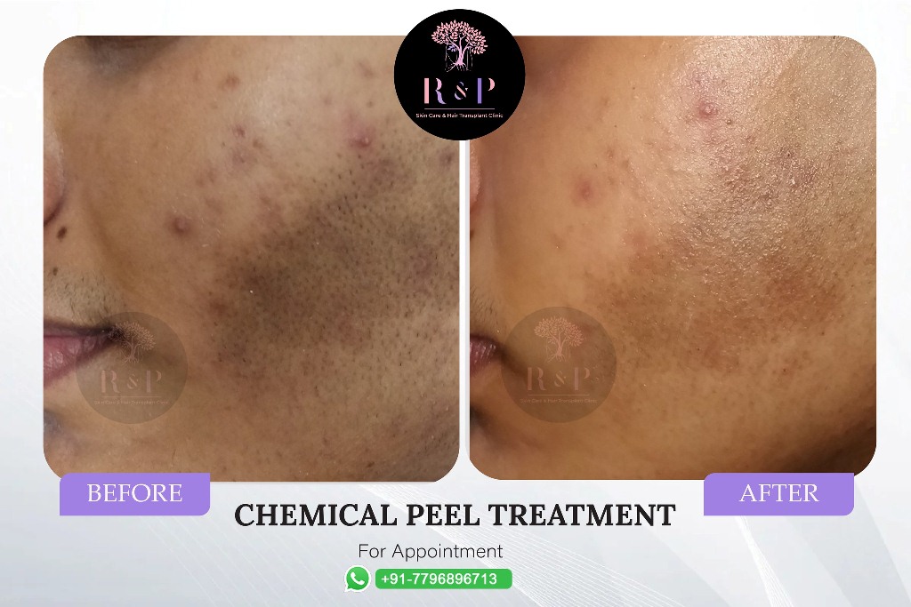 results-skintreatment-drrashmiaderao-bizknow.in-3