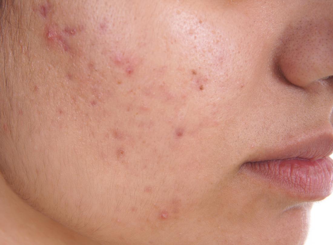 acne treatment in pimple saudagar