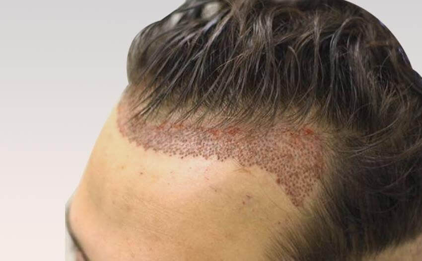hair-tratment-clinic-in-pimple-saudagar