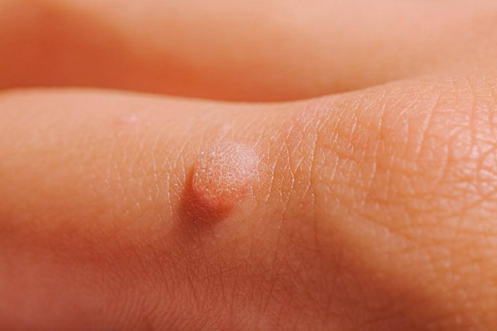 acne pimple treatment in pimple saudagar
