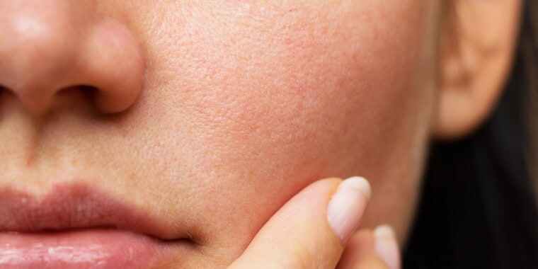 skin treatment in moshi